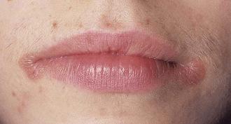How to quickly cure jams in the corners of the mouth or on the lips?