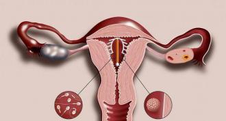 Installation of an intrauterine device - when is it better to install?